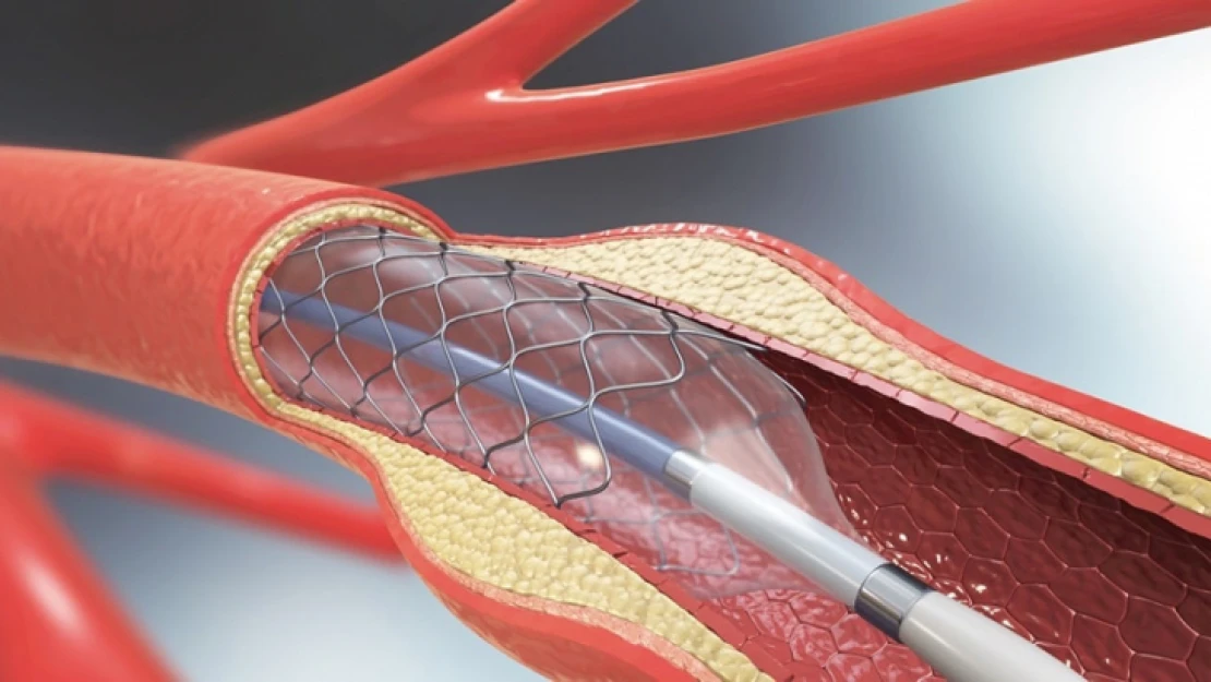 Kalbe Stent Takılmasının Amacı Nedir?