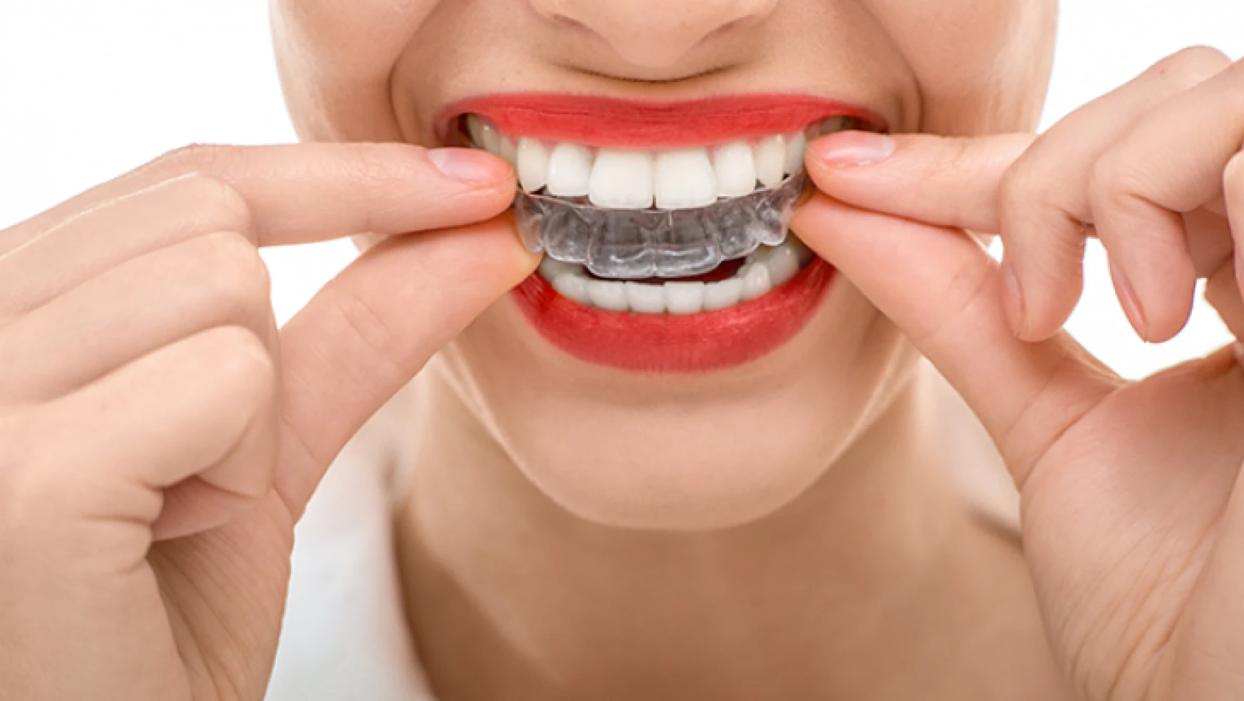 Ortodonti Tedavisi Nedir?